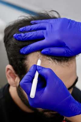Saç Ekimi ve Dermatolojik Değerlendirme: Doğru Teşhisin Önemi
